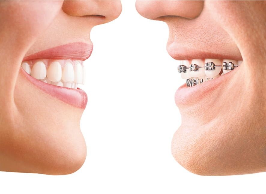 Invisalign vs. Braces: Which Option is Right for You in Mumbai?