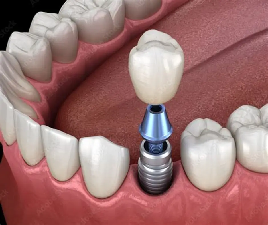 Why Painless Dentistry Is Becoming the First Choice for Patients in 2026