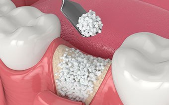 Bone grafting