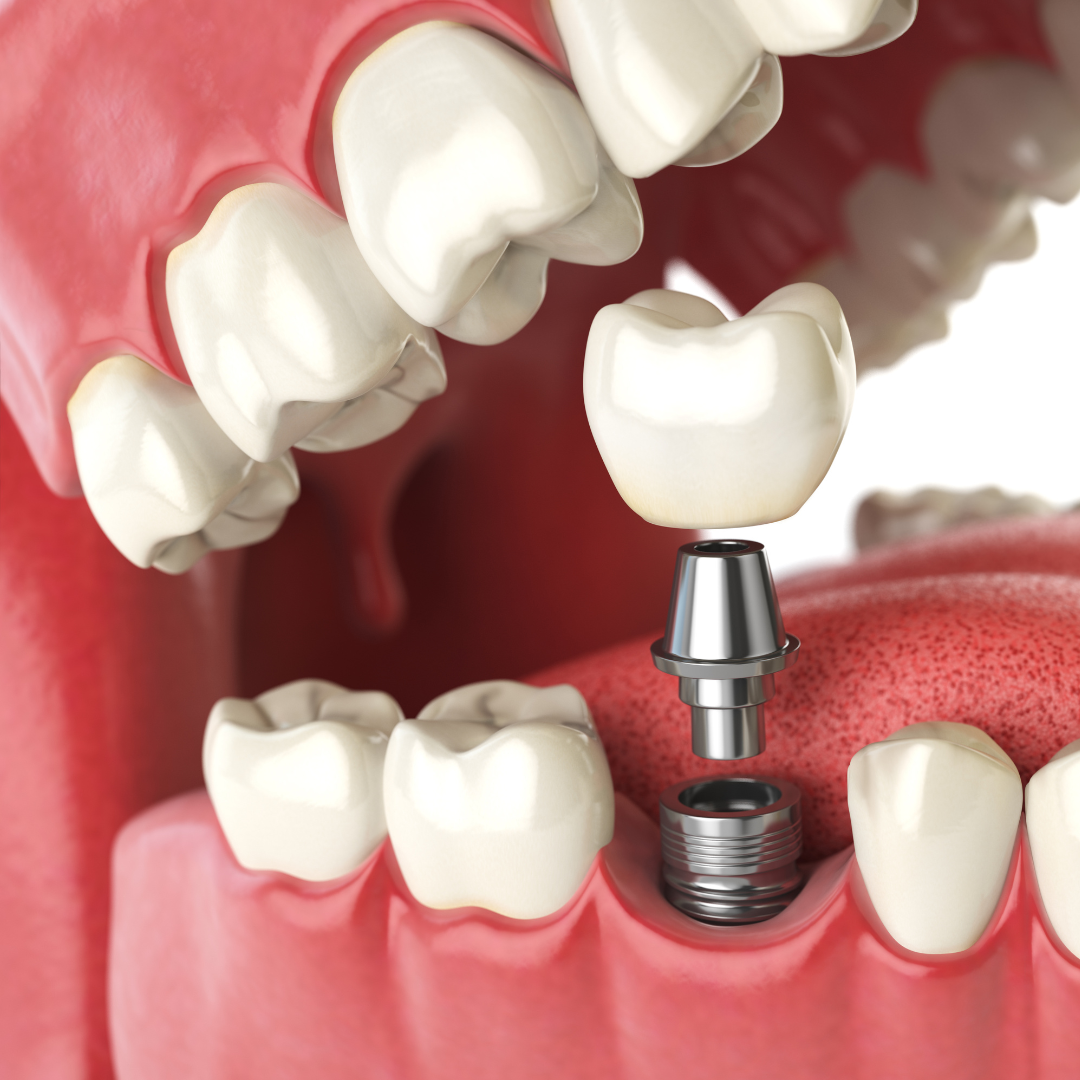 Premium dental implants