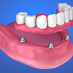 Dentures