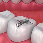 Esthetic Fillings