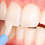 Fluoride Application