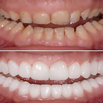 Full Mouth Rehabilitation