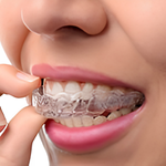 Invisible Aligners