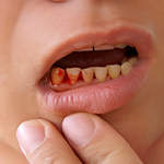Bleeding Gums