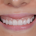 Lip Repositioning