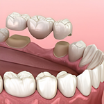 Premium Crowns
