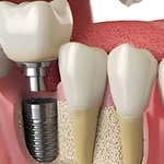 Premium Implants