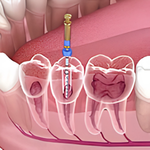 Root Canal