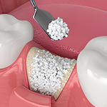 Bone Grafting