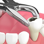 Extractions