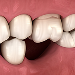 Bone Loss
