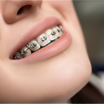 Braces