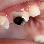 Cavity