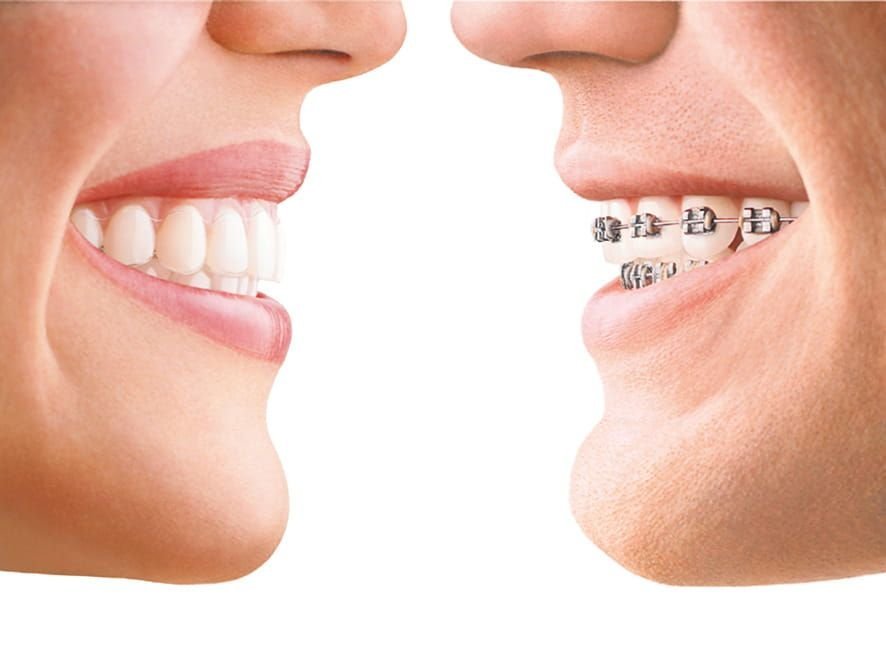 Invisalign vs. Braces: Which Option is Right for You in Mumbai?