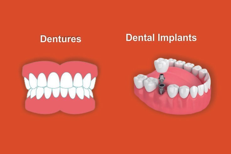 Dental Implants vs. Dentures: A Comprehensive Comparison