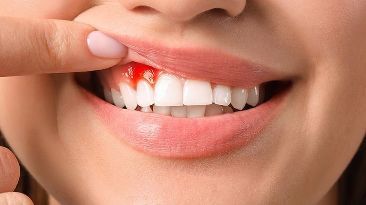 Gum treatment and gum health care at Dental Dynasty