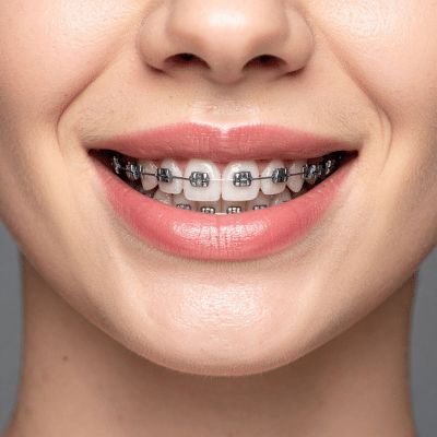 Dental braces