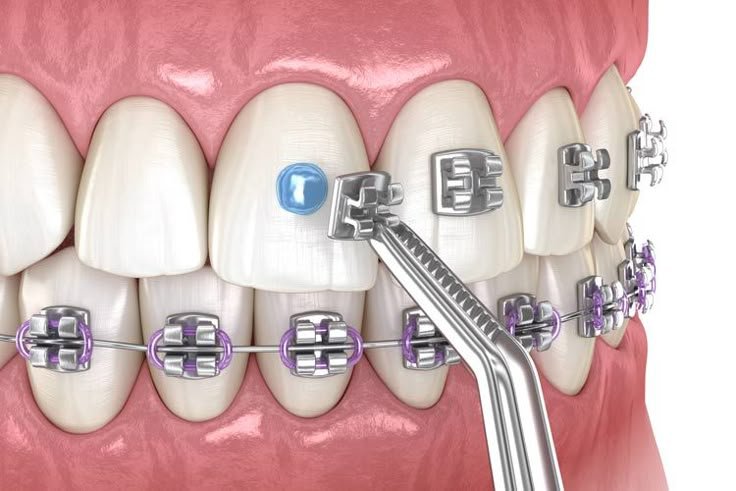 Dental braces for adults