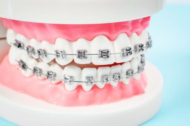 Traditional dental braces